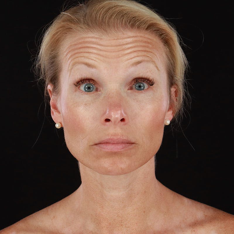 Botox/Dysport/Jeuveau Before & After Gallery - Patient 188515446 - Image 3