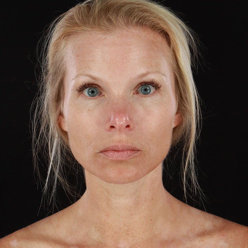 Botox/Dysport/Jeuveau Before & After Gallery - Patient 188515446 - Image 4