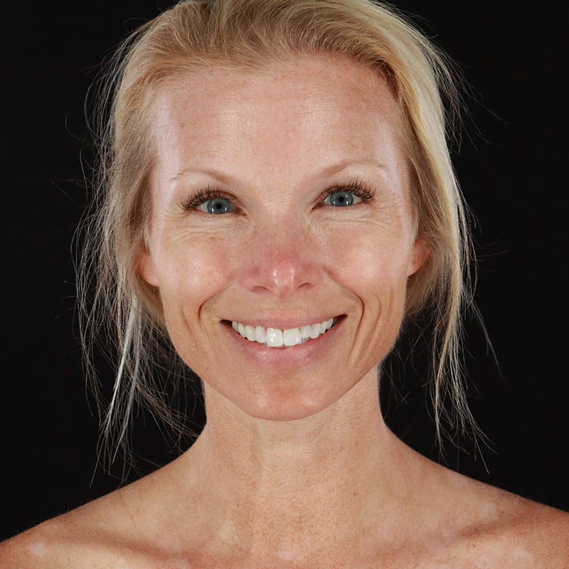 Botox/Dysport/Jeuveau Before & After Gallery - Patient 188515446 - Image 6