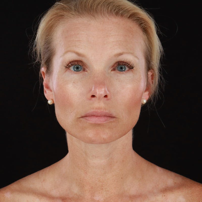 Botox/Dysport/Jeuveau Before & After Gallery - Patient 188515446 - Image 7