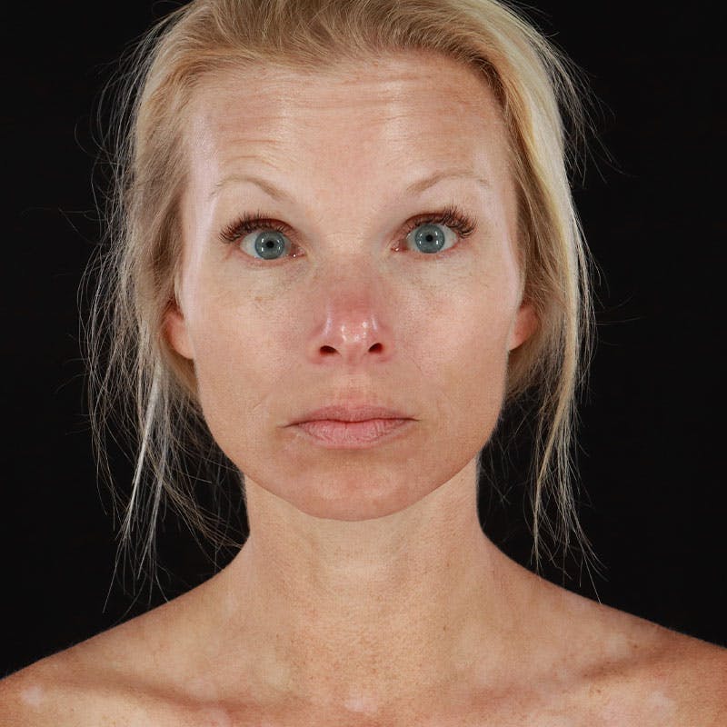 Botox/Dysport/Jeuveau Before & After Gallery - Patient 188515446 - Image 8