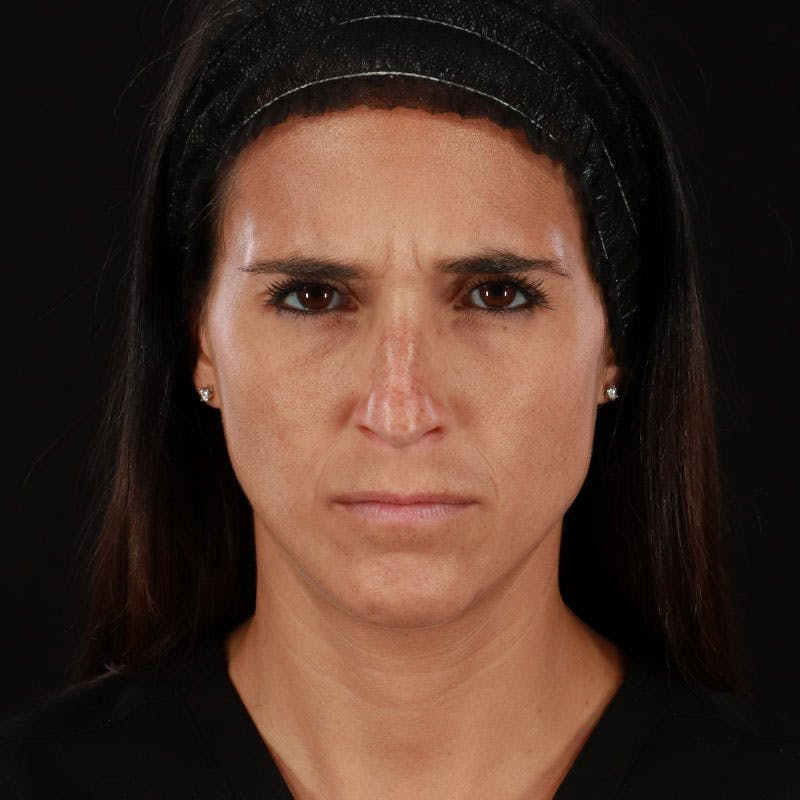 Botox/Dysport/Jeuveau Before & After Gallery - Patient 188515450 - Image 3