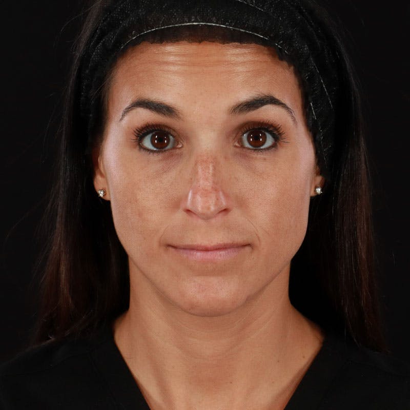 Botox/Dysport/Jeuveau Before & After Gallery - Patient 188515450 - Image 5