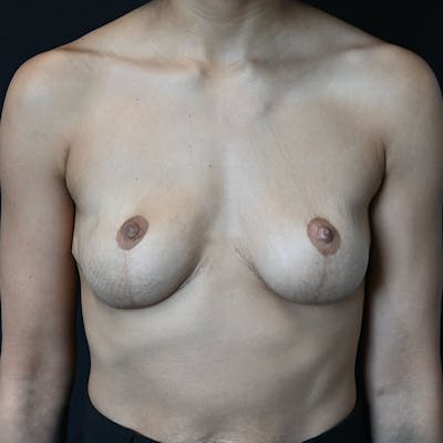 Breast Explant with Lift Before & After Gallery - Patient 188517512 - Image 2