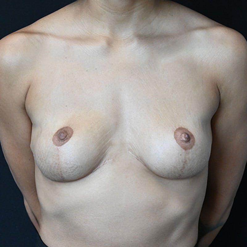 Breast Explant with Lift Before & After Gallery - Patient 188517512 - Image 4
