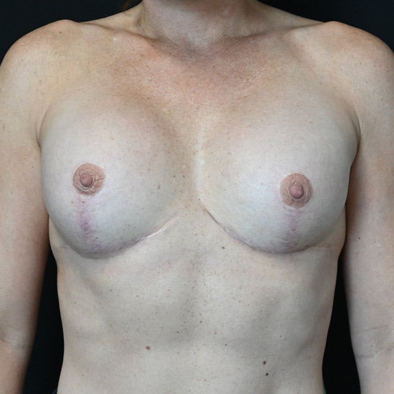 Breast Revision Before & After Gallery - Patient 188532017 - Image 2