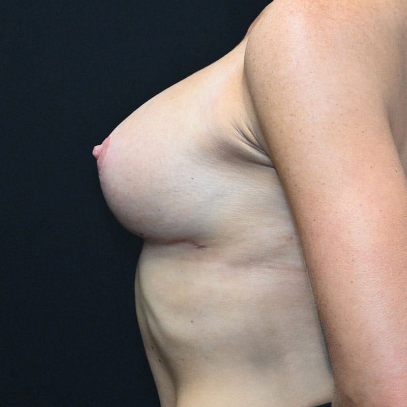 Breast Revision Before & After Gallery - Patient 188532017 - Image 10