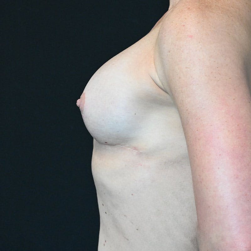 Breast Revision Before & After Gallery - Patient 188532017 - Image 9