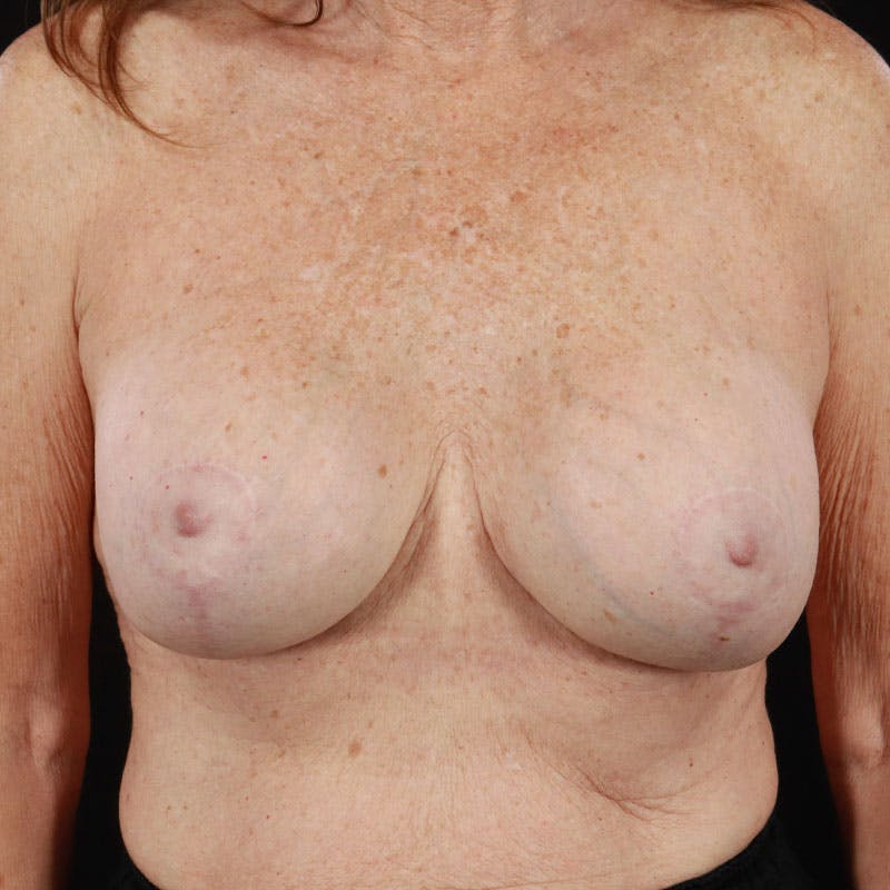Breast Augmentation with Lift Before & After Gallery - Patient 188534128 - Image 2
