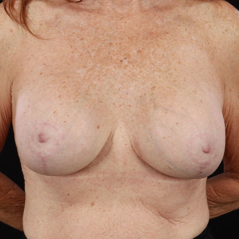 Breast Revision Before & After Gallery - Patient 188532030 - Image 4
