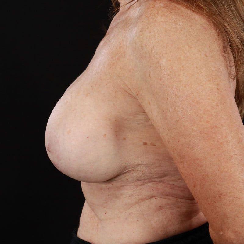 Breast Augmentation with Lift Before & After Gallery - Patient 188534128 - Image 10