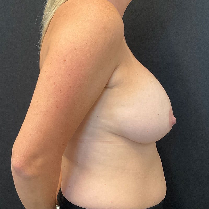 Breast Revision Before & After Gallery - Patient 188532037 - Image 5