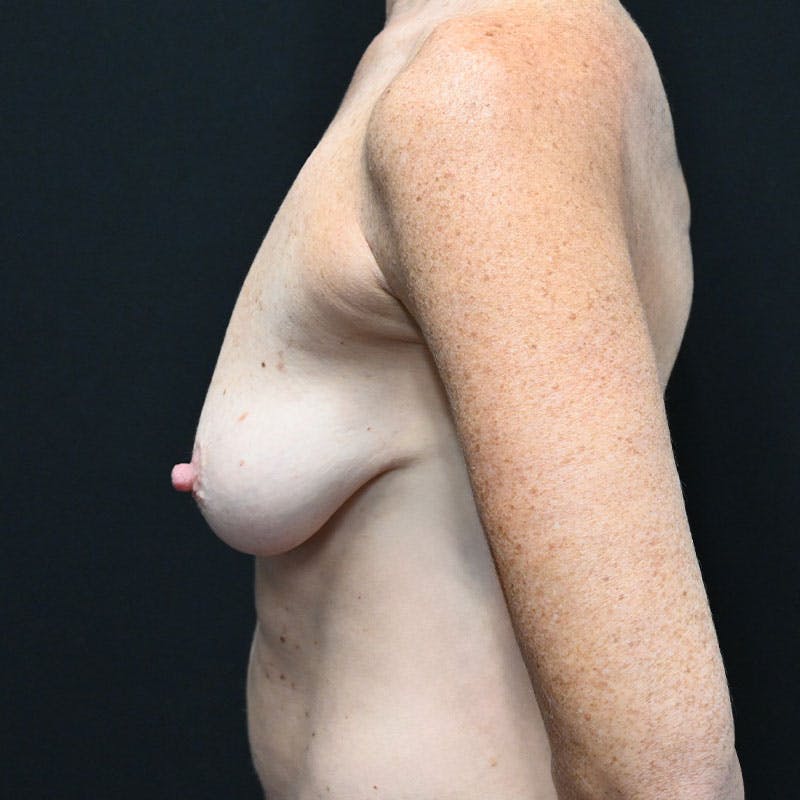 Breast Lift Before & After Gallery - Patient 188532065 - Image 11