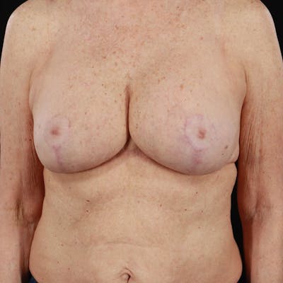 Breast Augmentation with Lift Before & After Gallery - Patient 188534131 - Image 2