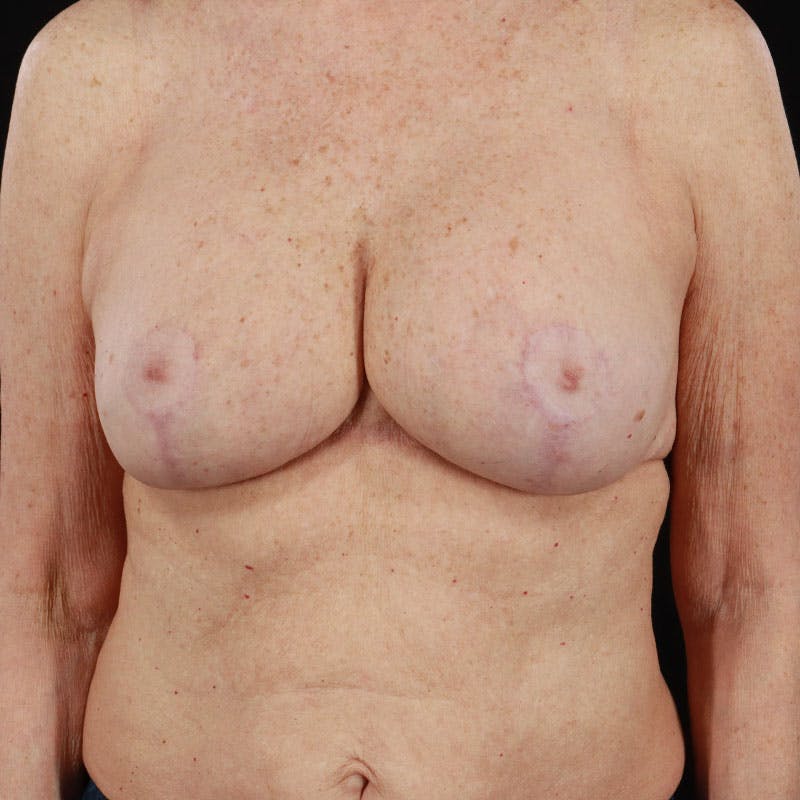 Breast Augmentation with Lift Before & After Gallery - Patient 188534131 - Image 2