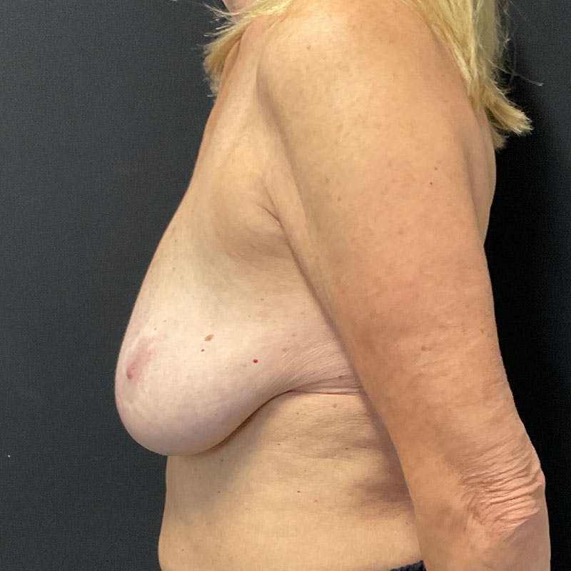 Breast Augmentation with Lift Before & After Gallery - Patient 188534131 - Image 9