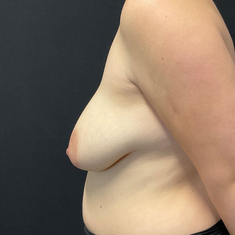 Breast Augmentation with Lift Before & After Gallery - Patient 188534126 - Image 7