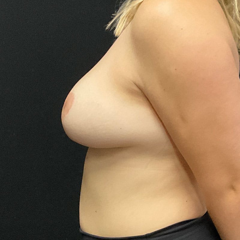Breast Augmentation with Lift Before & After Gallery - Patient 188534126 - Image 8
