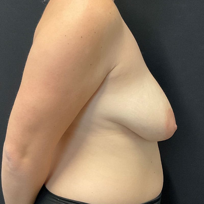 Breast Augmentation with Lift Before & After Gallery - Patient 188534126 - Image 11