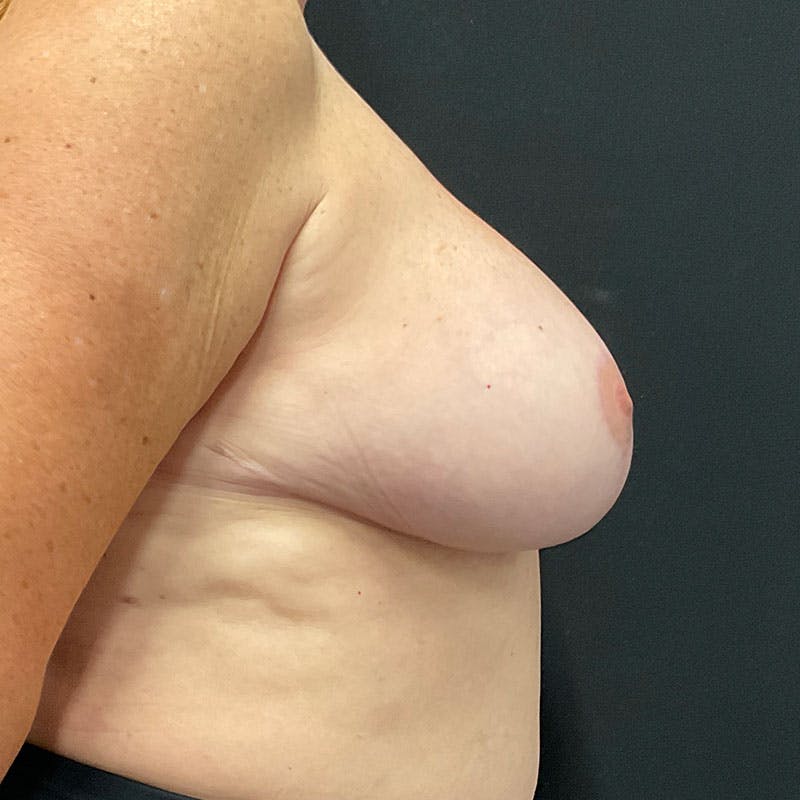 Breast Reduction Before & After Gallery - Patient 188534132 - Image 6