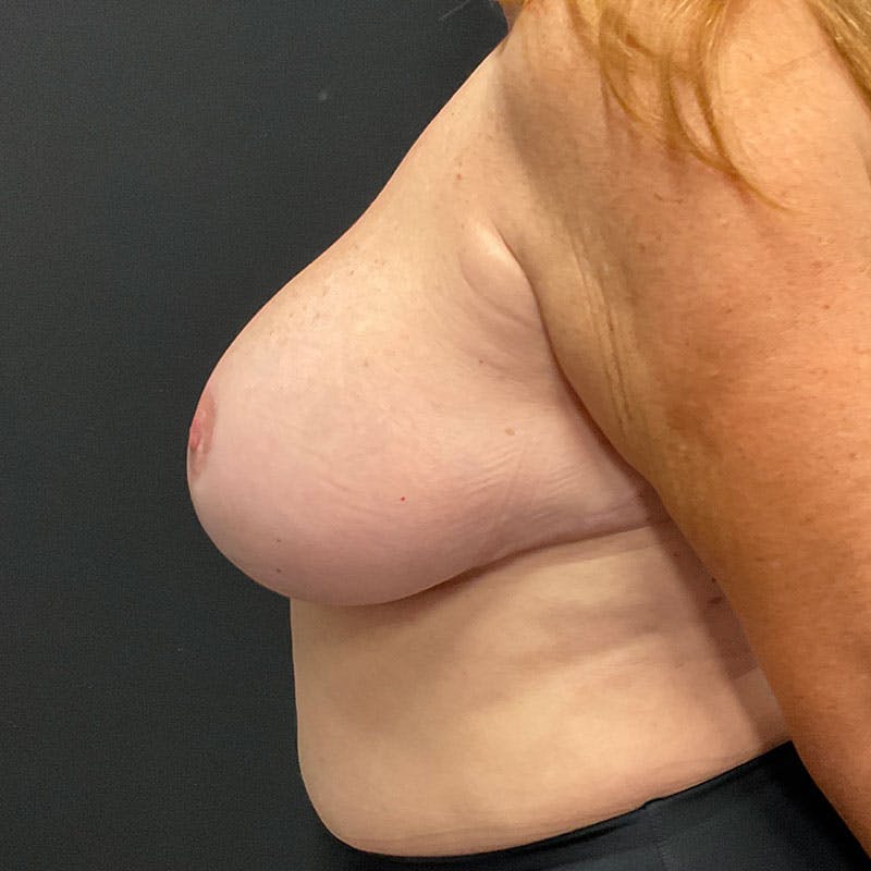 Breast Reduction Before & After Gallery - Patient 188534132 - Image 10