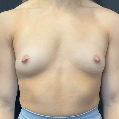 Breast Augmentation Before & After Gallery - Patient 172876542 - Image 1