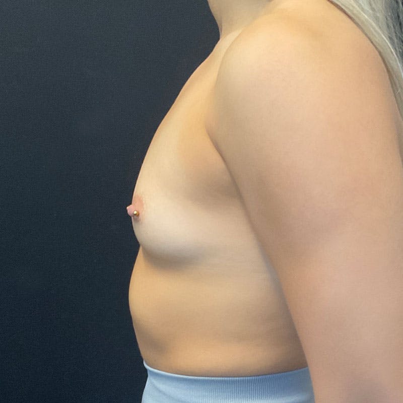 Breast Augmentation Before & After Gallery - Patient 172876542 - Image 9