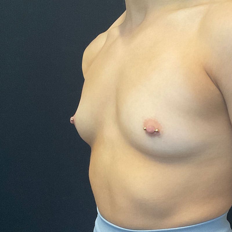 Breast Augmentation Before & After Gallery - Patient 172876542 - Image 11