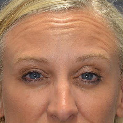 Botox/Dysport/Jeuveau Before & After Gallery - Patient 191230890 - Image 1