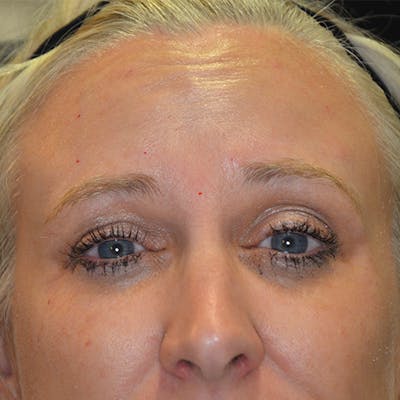 Botox/Dysport/Jeuveau Before & After Gallery - Patient 191230890 - Image 2