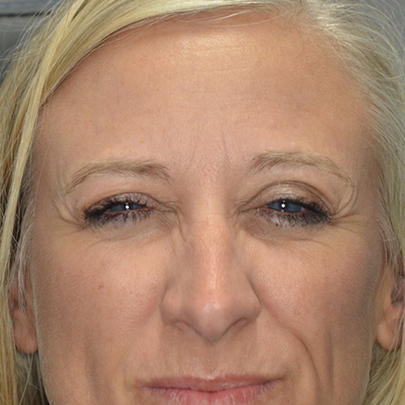 Botox/Dysport/Jeuveau Before & After Gallery - Patient 191230890 - Image 3