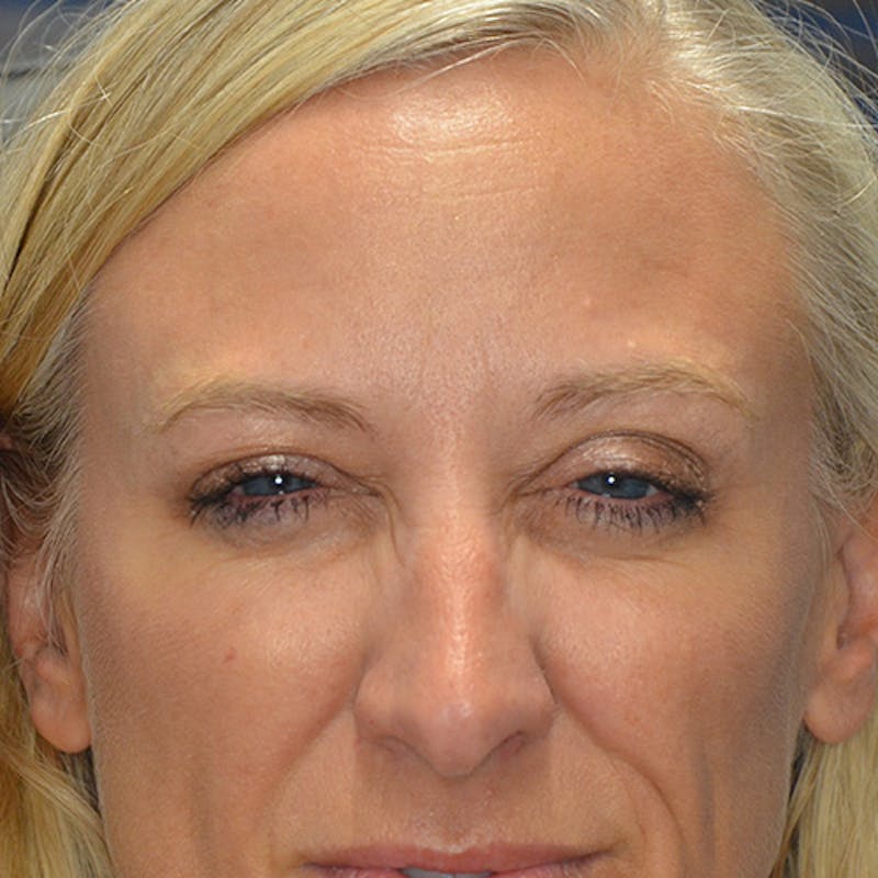 Botox/Dysport/Jeuveau Before & After Gallery - Patient 191230890 - Image 4