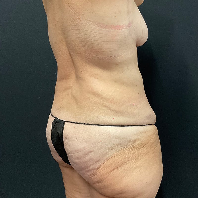 Body Lift Before & After Gallery - Patient 196483766 - Image 7
