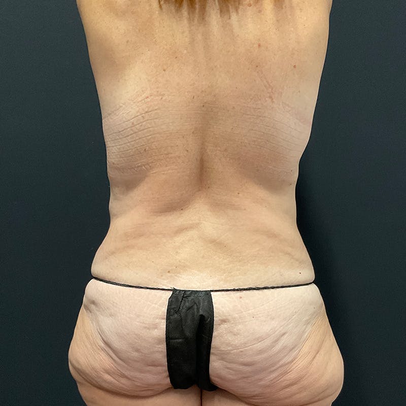 Body Lift Before & After Gallery - Patient 196483766 - Image 9