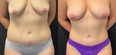 Bodytite By Inmode Before & After Gallery - Patient 196483776 - Image 1