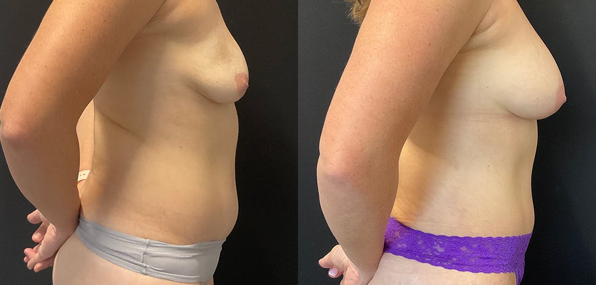 Bodytite By Inmode Before & After Gallery - Patient 196483776 - Image 3