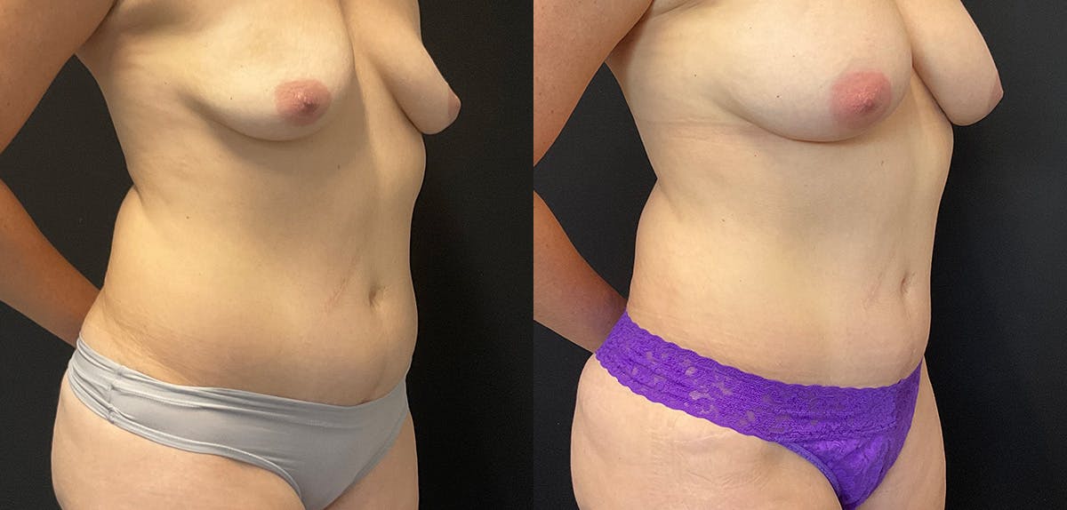 Bodytite By Inmode Before & After Gallery - Patient 196483776 - Image 2