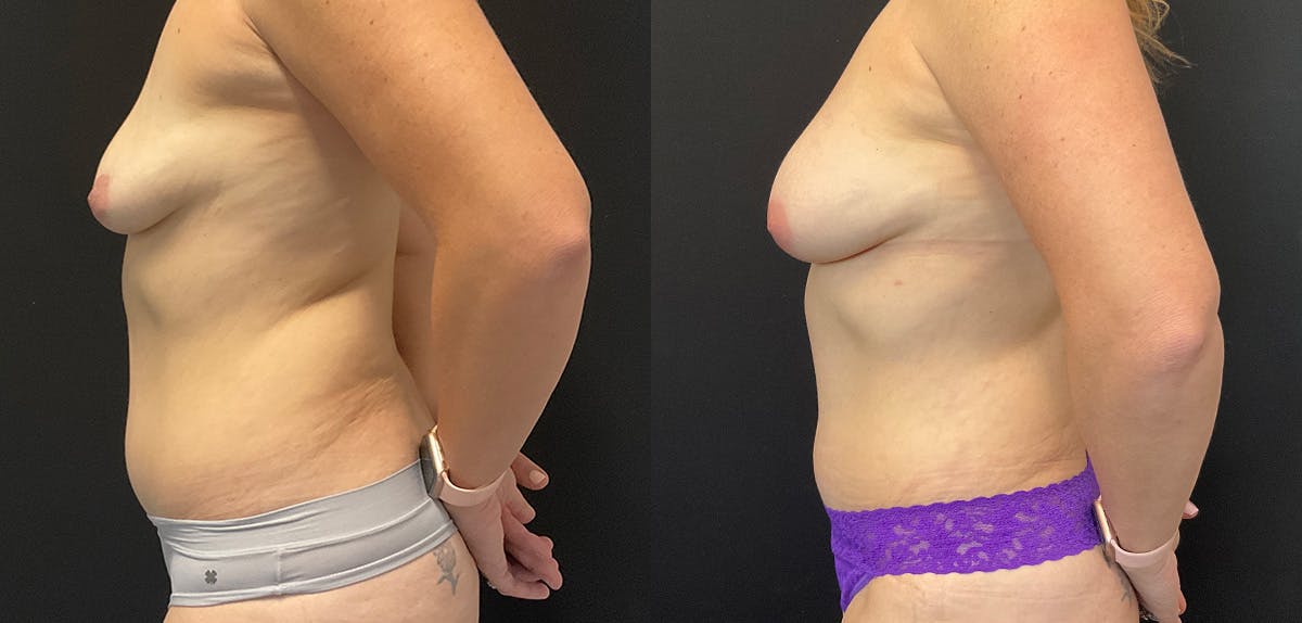 Bodytite By Inmode Before & After Gallery - Patient 196483776 - Image 5