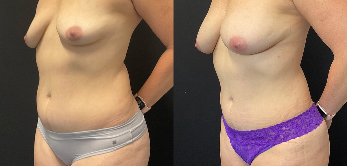 Bodytite By Inmode Before & After Gallery - Patient 196483776 - Image 4
