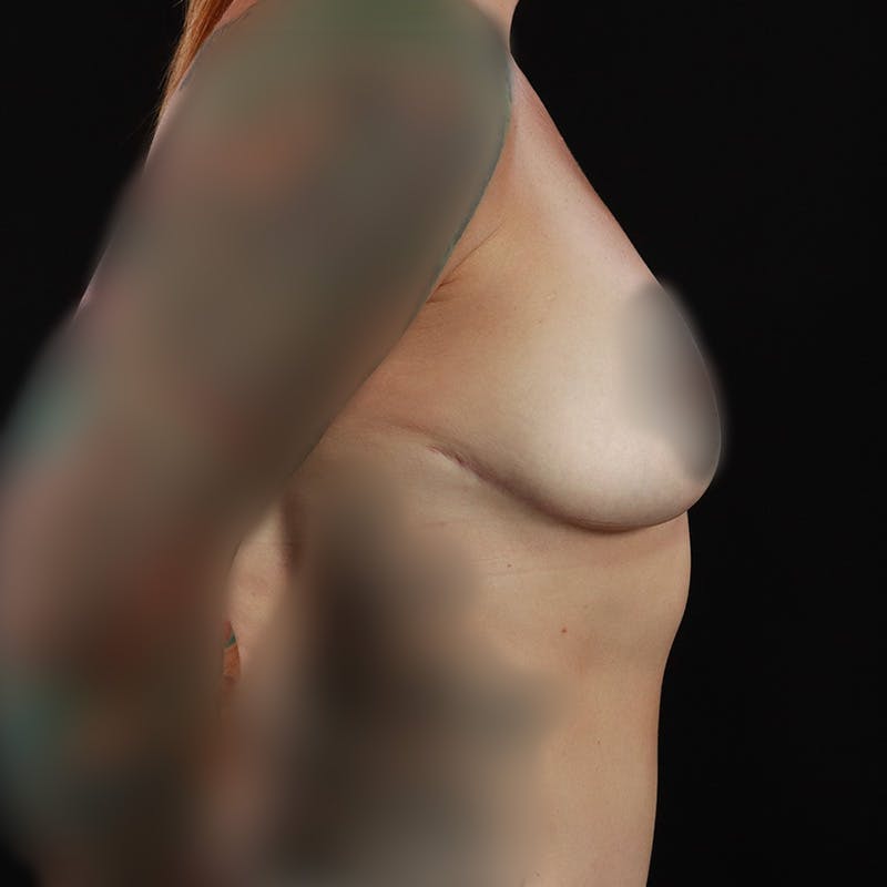 Breast Lift Before & After Gallery - Patient 732129 - Image 6