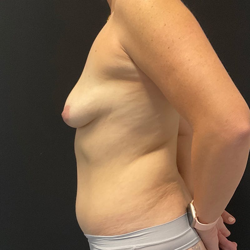 Liposuction Before & After Gallery - Patient 196486615 - Image 9