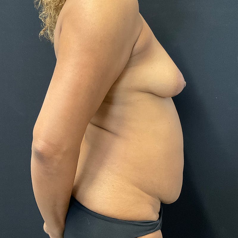 Abdominoplasty (Tummy Tuck) Before & After Gallery - Patient 196486669 - Image 5