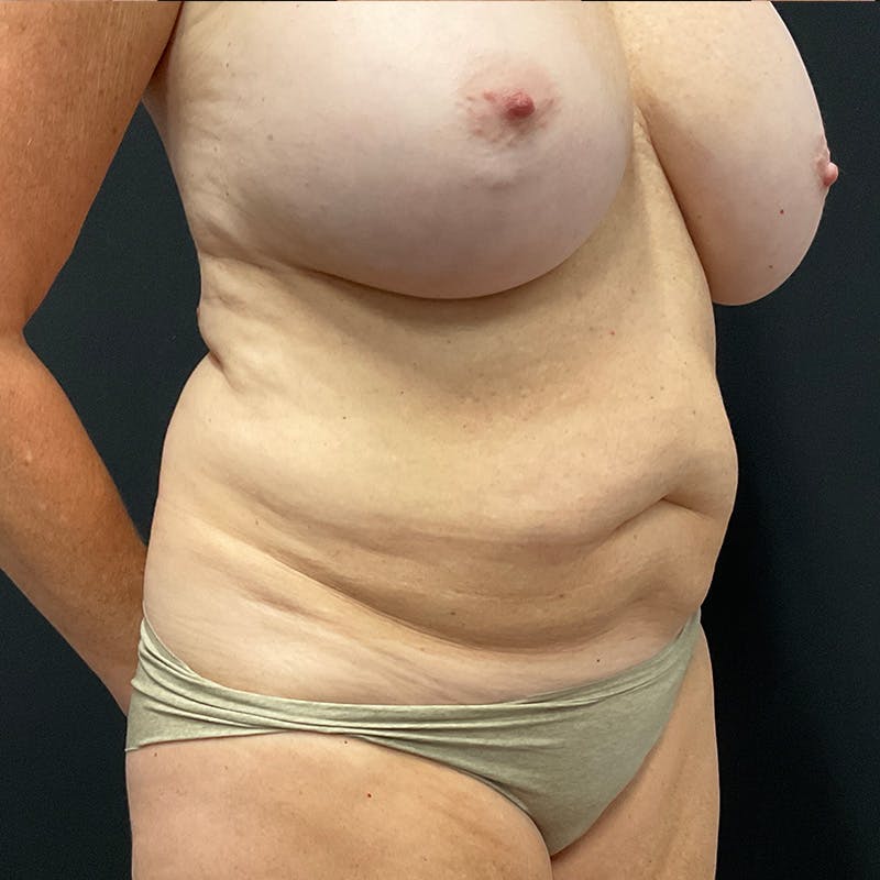 Abdominoplasty (Tummy Tuck) Before & After Gallery - Patient 196486667 - Image 3