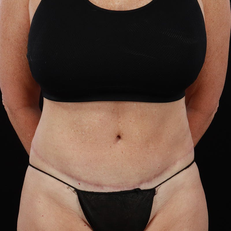 Abdominoplasty (Tummy Tuck) Before & After Gallery - Patient 196486667 - Image 2