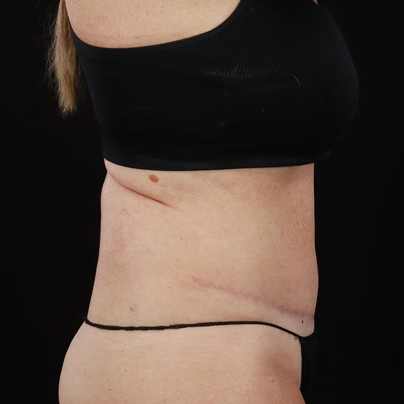 Abdominoplasty (Tummy Tuck) Before & After Gallery - Patient 196486667 - Image 6