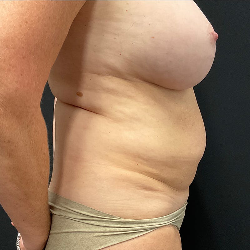 Abdominoplasty (Tummy Tuck) Before & After Gallery - Patient 196486667 - Image 5