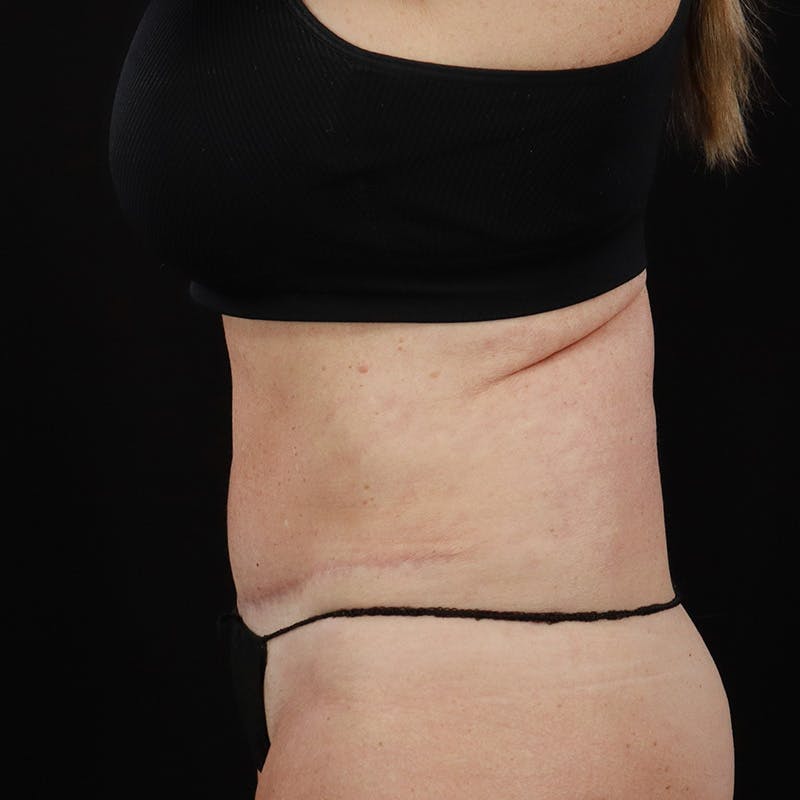 Abdominoplasty (Tummy Tuck) Before & After Gallery - Patient 196486667 - Image 10