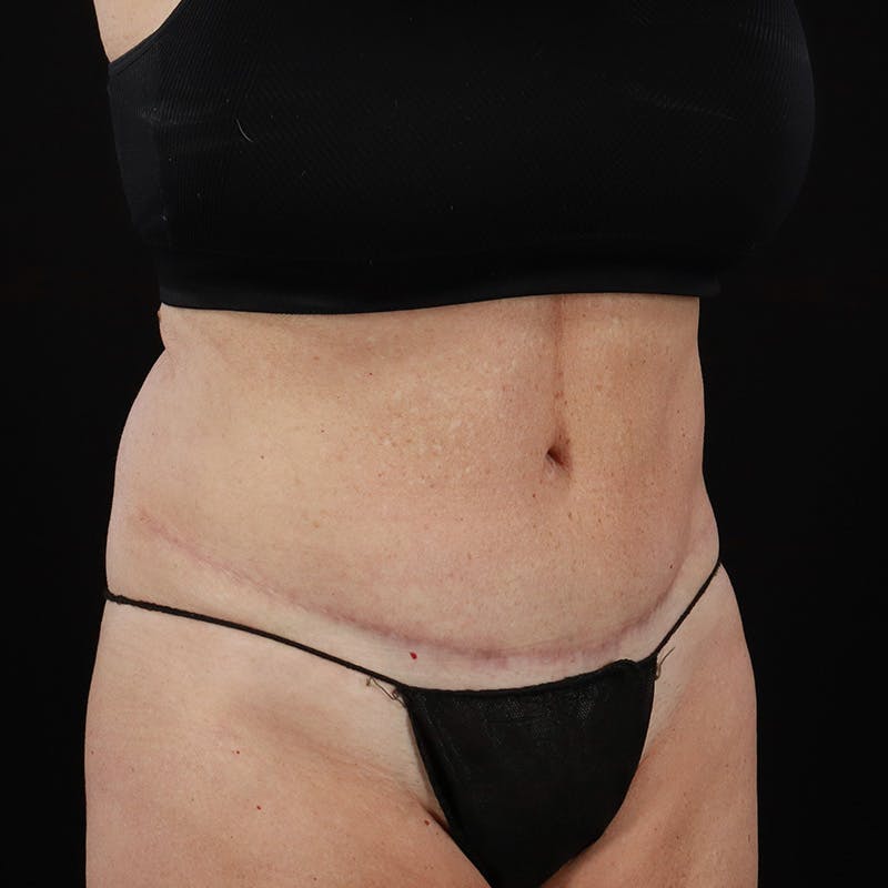 Abdominoplasty (Tummy Tuck) Before & After Gallery - Patient 196486667 - Image 4