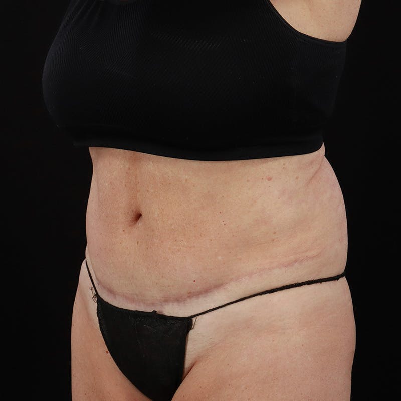 Abdominoplasty (Tummy Tuck) Before & After Gallery - Patient 196486667 - Image 8