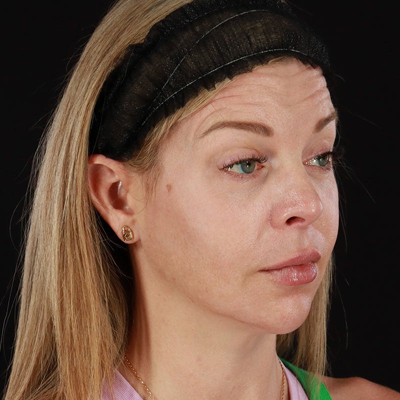 SkinTyte Before & After Gallery - Patient 201480858 - Image 2